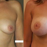 zvětšení prsou, augmentace prsou, anatomický implantát