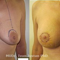 modelace prsou s implantátem, kulatý prsní implantát