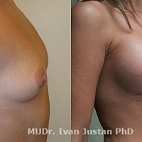 Fotogalerie - zvětšení prsou