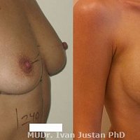 Fotogalerie - zvětšení prsou