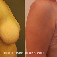 Fotogalerie - zmenšení prsou