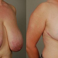 Fotogalerie - zmenšení prsou