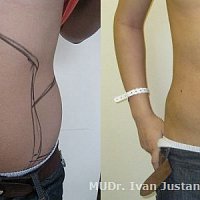 Kombinace odsátí tuku z břicha a boků u muže - operace v celkové narkoze