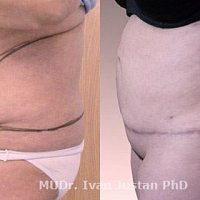 abdominoplastika s liposukcí boků dohromady