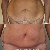 foto před abdominoplastikou, s převisem břicha a po 6 měsících od operace se zhojenou jizvou před liposukcí boků