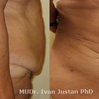 abdominoplastika kombinovaná s liposukcí břicha a boků s odstupem 6 měsíců