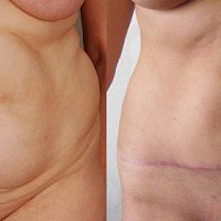 odstranění převisu břicha - abdominoplastika