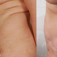 odstranění převisu břicha - abdominoplastika