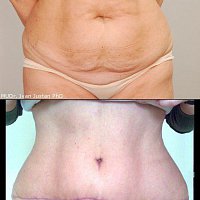 prostá abdominoplastika bez liposukce