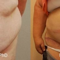 velký převis, tukový polštář břicha, boků a rozestup břišních svalů. Abdominoplastika kombinovaná se zpevněním svaloviny a s liposukcí břicha a boků