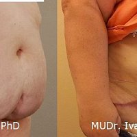 velký převis, tukový polštář břicha, boků a rozestup břišních svalů. Abdominoplastika kombinovaná se zpevněním svaloviny a s liposukcí břicha a boků