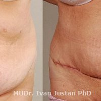 spíš kožní nadbytek v oblasti břicha řešený abdominoplastikou