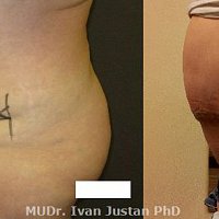 abdominoplastika se současným zpevněním svalové vrstvy břicha