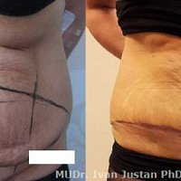 abdominoplastika se zpevněním svaloviny a odstraněním uvolněné kůže po porodu