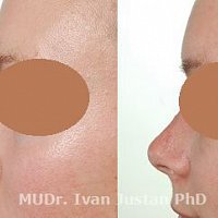 operace nosu -zmenšení nosu a jeho modelace