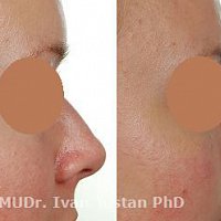 operace nosu - zmenšení a modelace nosu