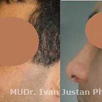 operace nosu - na přání klienta snížení hřbetu nosního a zvednutí špičky.