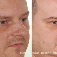plastická a funkční operace nosu - narovnání septa nosního a korekce hřbetu nosního
