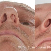 plastická a funkční operace nosu - vybočená přepážka nosní na foto